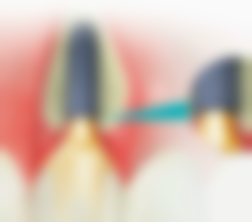 60岁的人能种植牙吗——风险防范