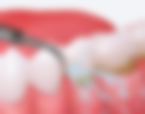 拔牙后可以马上种植吗之 3 个月修复期:遵循“黄金法则”