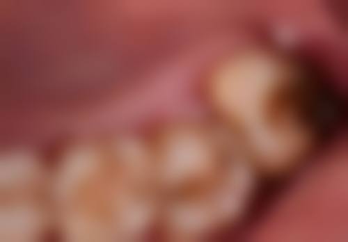 60岁有高血压老人适合种植牙吗