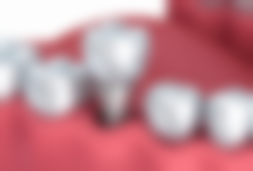 广州牙爱美口腔怎么样，抖音团购活动和价格表