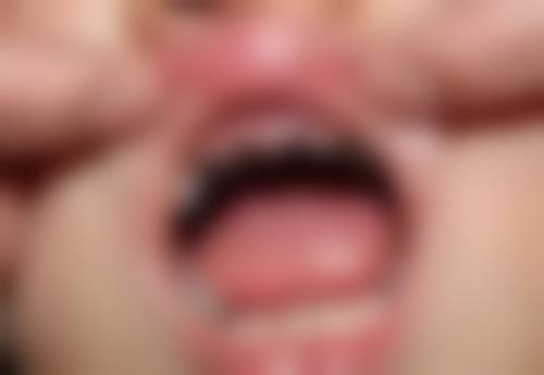 种植牙齿钴铬合金材质：经济之选