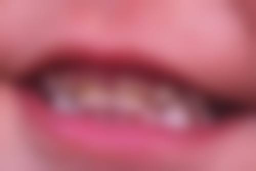 60岁种植牙的注意事项：武汉中诺口腔医院术前术后全攻略