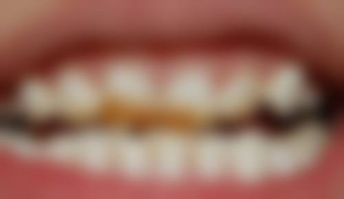 种植牙如何选择品牌