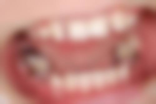 拔牙可以直接种植吗？揭秘即拔即种条件+费用，90%人不知道的真相