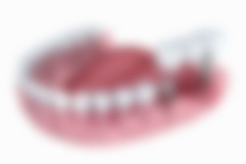 北京京大博爱口腔门诊部8000元美国皓圣种植牙顾客实例想象