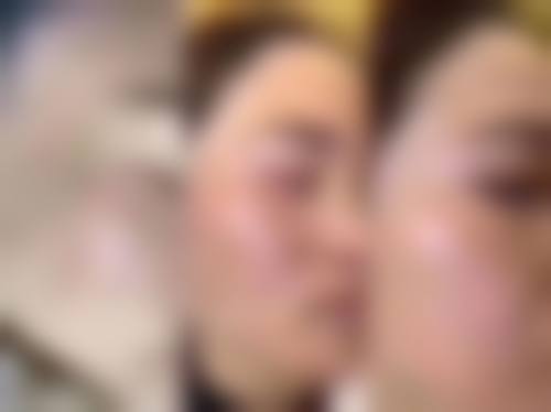 临床实例分享:徐正一,天津缪慈医疗美容门诊部